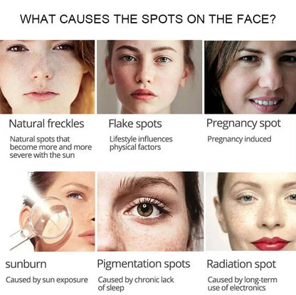 Powerful Spot-removing Whiten Cream Brighten Skin Fast Eliminates Melanin Pigmentation Melasma Dark Spots Moisturize Beauty Gel